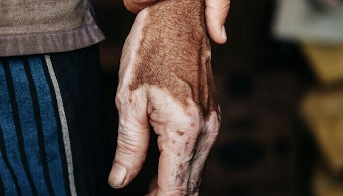 Händer med vitiligo eller hudåkomma sökes till reklamkampanj (Stockholm)